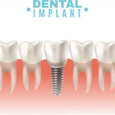 dental-implant-adentaloffice