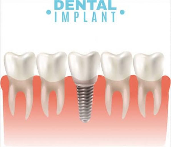 dental-implant-adentaloffice