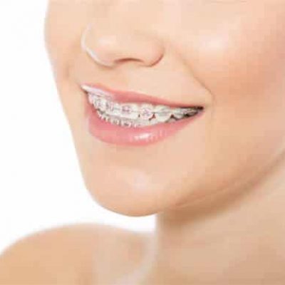 orthodontics-adentaloffice