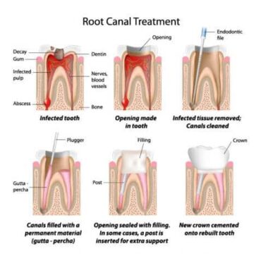 root-canal-treatment-adentaloffice