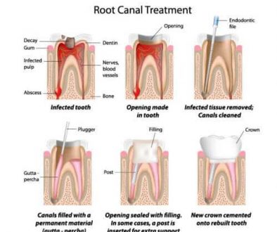 root-canal-treatment-adentaloffice