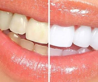 teeth-whitening-adentaloffice
