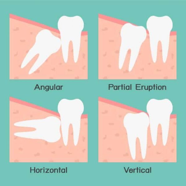 wisdom-teeth-removal-adentaloffice