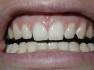 Featured image for: Do You Grind Or Clench Your Teeth?