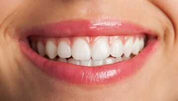 teeth-whitening-adentaloffice