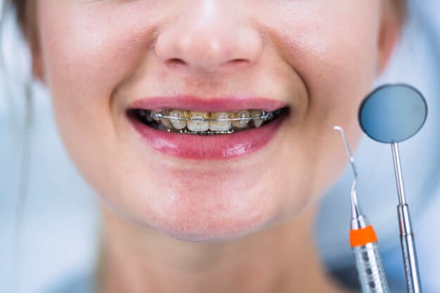Featured image for: Caring for Your Braces