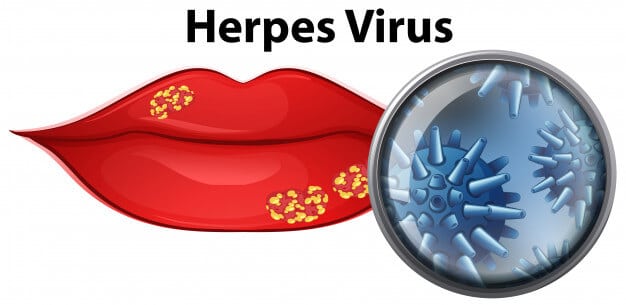 Featured image for: Cold Sores