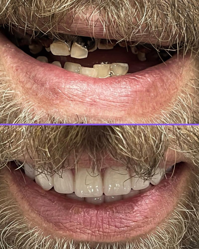All-On-X dental implants case 1, before and after at A Dental Office in Barrie, Ontario