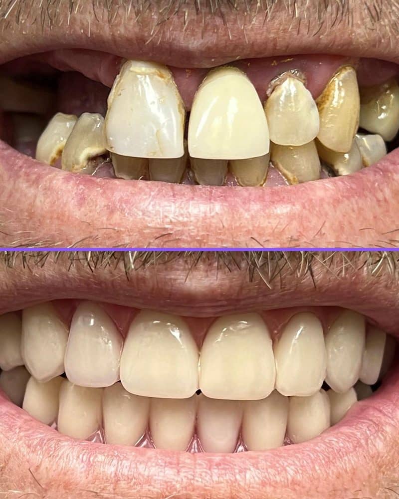 All-On-X dental implants case 2, before and after at A Dental Office in Barrie, Ontario