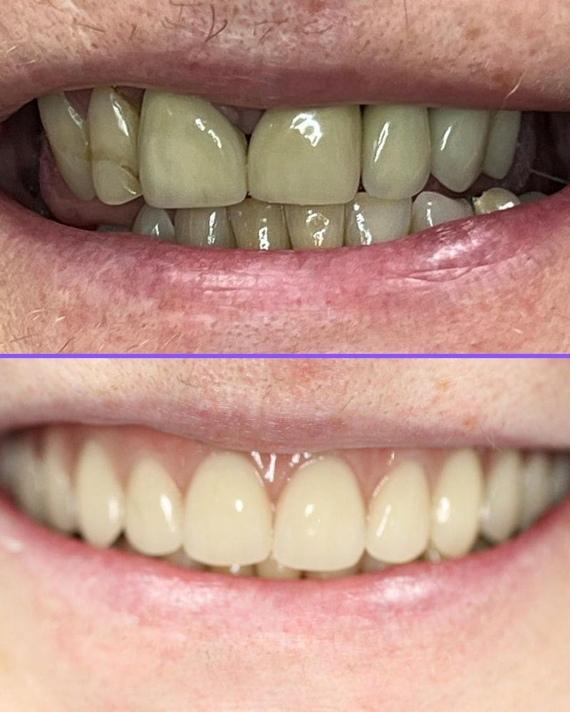 All-On-X dental implants case 3, before and after at A Dental Office in Barrie, Ontario