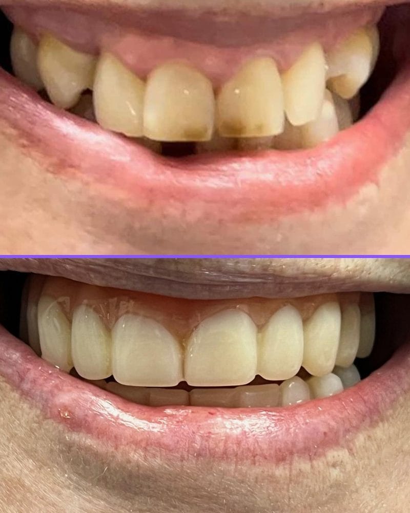 All-On-X dental implants case 4, before and after at A Dental Office in Barrie, Ontario